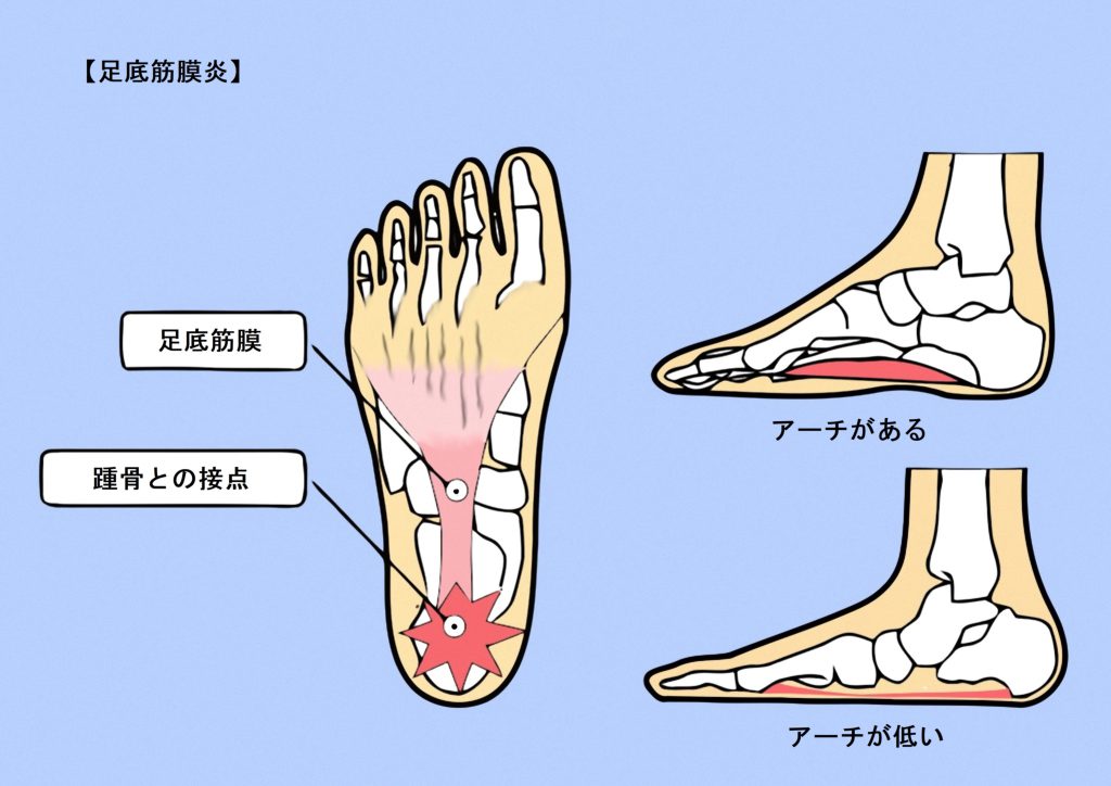 足の裏の痛み 足底筋膜炎 福岡ふっと